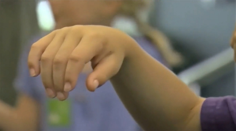 Acute flaccid myelitis
