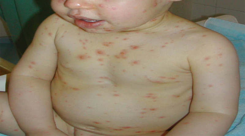 Chickenpox disease