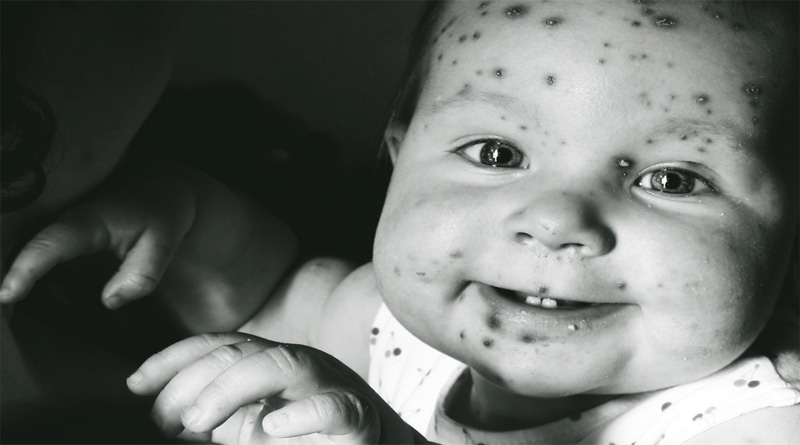 Monkeypox disease