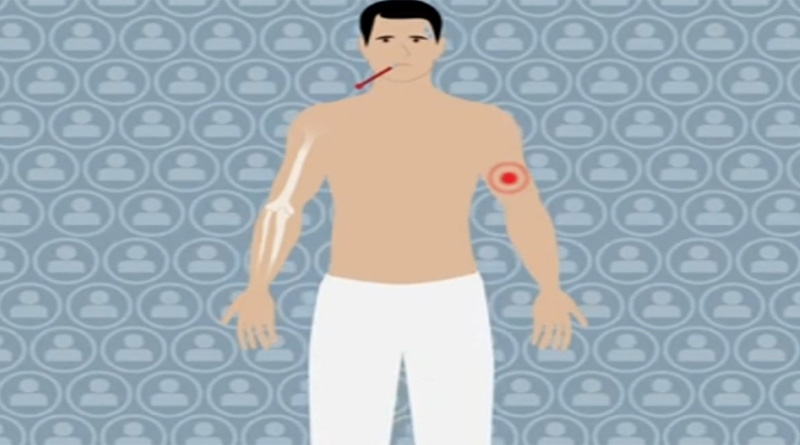 Anaplasmosis