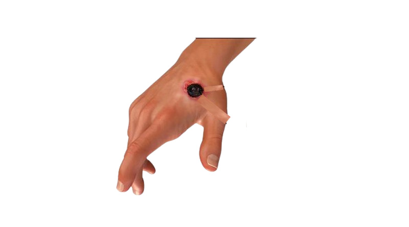 anthrax disease