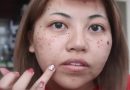 Acne spots on face