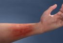 Atopic Eczema on arm