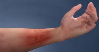 Atopic Eczema on arm